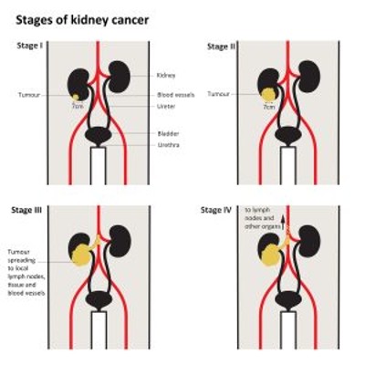 Stages of Kidney Cancer